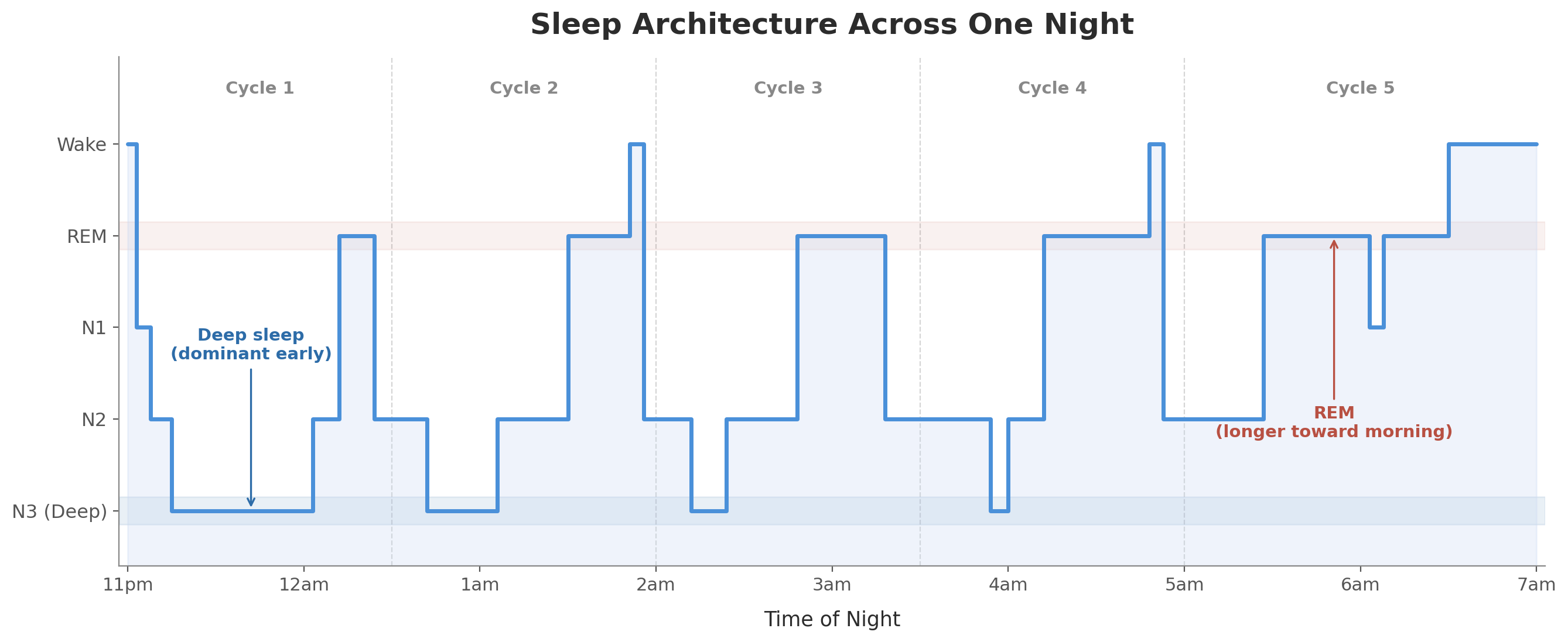 Hypnogram showing five sleep cycles across one night, with deep sleep concentrated in the first half and REM periods growing longer toward morning.